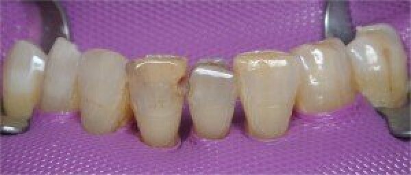 CLINICAL CASE : ADHESIVE DENTISTERY / AESTHETIC DENTISTERY