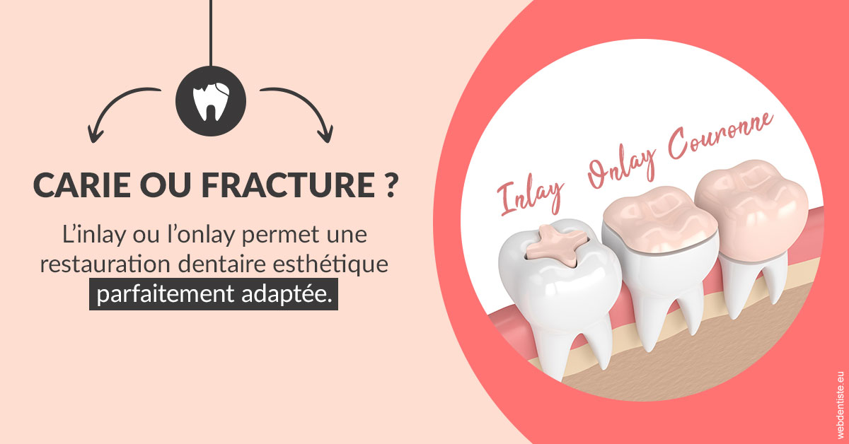 https://dr-hassaneyn-anglais.test-moncomptewebdentiste.fr/T2 2023 - Carie ou fracture 2