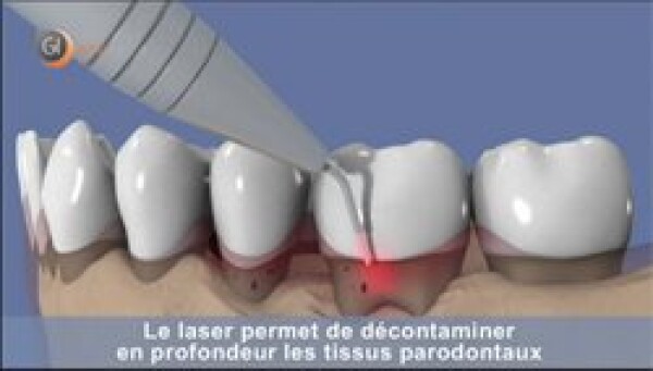 WHY LASERS ARE USED IN DENTISTERY ?
