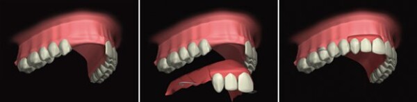 WHAT IS A PARTIAL DENTURE ?