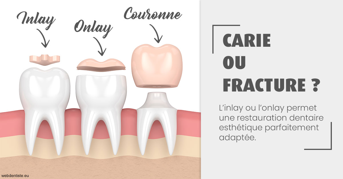 https://dr-hassaneyn-anglais.test-moncomptewebdentiste.fr/T2 2023 - Carie ou fracture 1