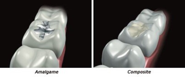 HOW TO RESTORE A TOOTH ? DIRECT TECHNIQUES