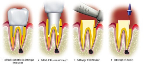 INFILTRATION AND REPLACEMENT CROWNS
