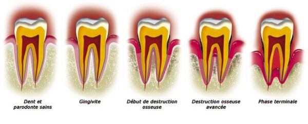 WHAT IS PERIODONTISIS ?