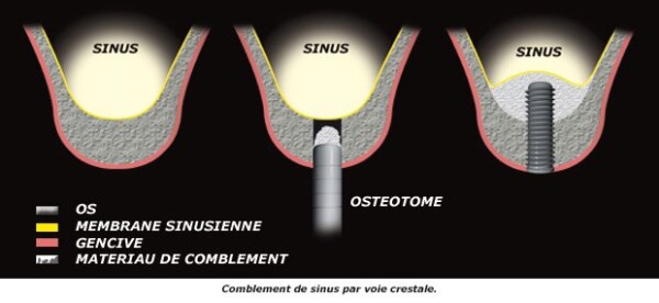 SINUS FILLINGS OR SINUS LIF BY THE CRESTAL APPROACH