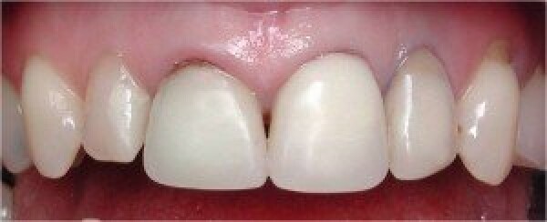 CLINICAL CASE : IMPLANT CONVENTIONAL SOLID : CROWNS AND BRIDGES
