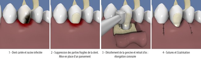 elongation-1